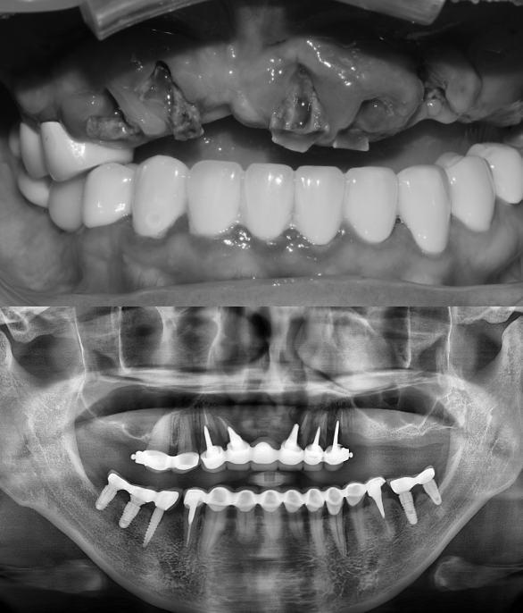 수술 전